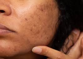 How Long Does it Realistically Take to Fade Dark Spots Naturally?